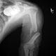 Broken Arm X-ray