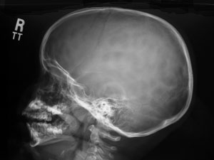 Lateral Skull X-ray