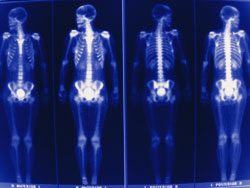 Nuclear Medicine X-ray