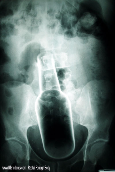 Beer Bottle X-ray
